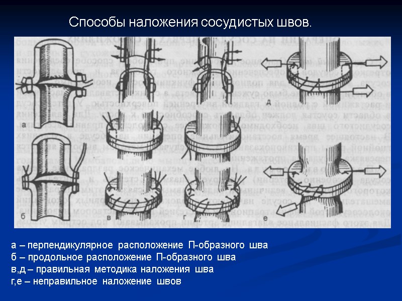 Способы наложения сосудистых швов. а – перпендикулярное расположение П-образного шва б – продольное расположение